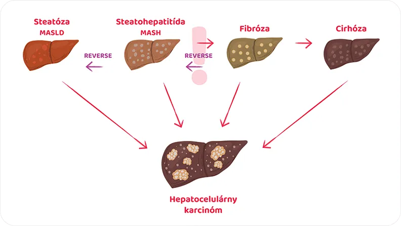 schéma znázorňujúca vývoj MASLD až k rakovine pečene